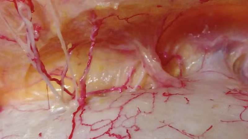 Understanding and Avoiding Toxin-related Adverse Events: Glabella