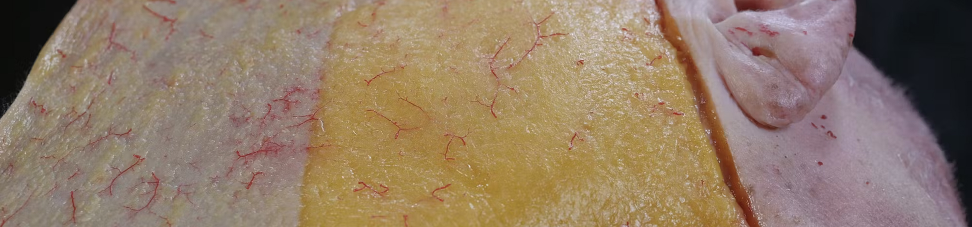 Biostimulator Treatments: Tightening the Lateral Face