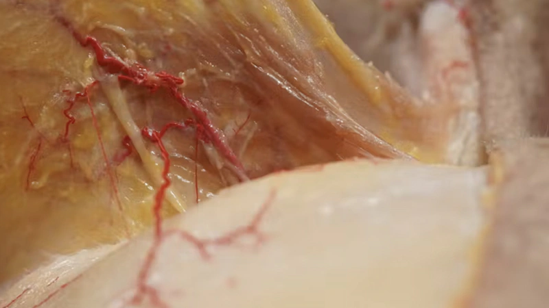 Treating Glabellar Lines with Fillers: Supraperiosteal Cannula Technique