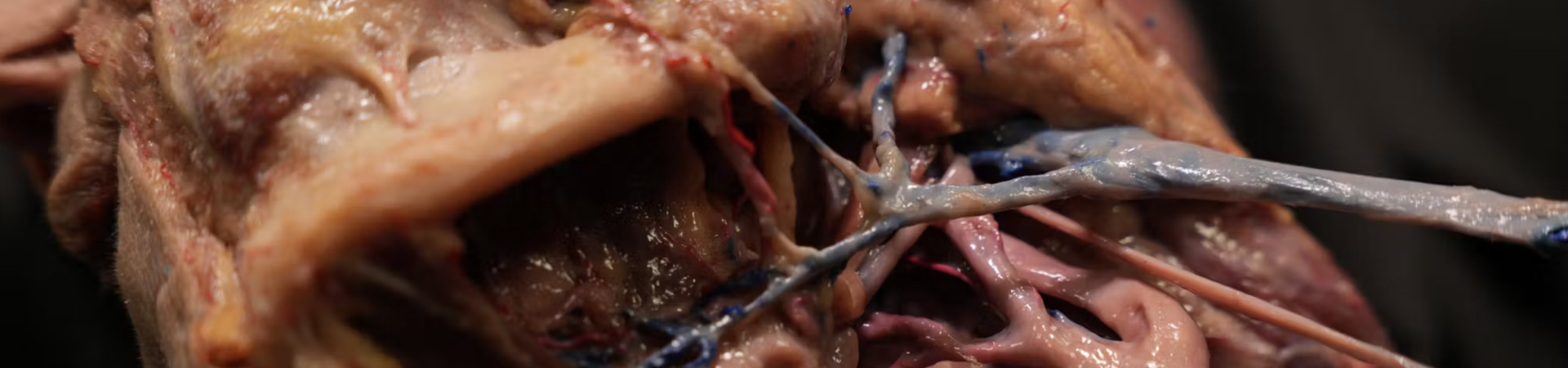 Understanding and Avoiding Toxin-related Adverse Events: Platysma Muscle