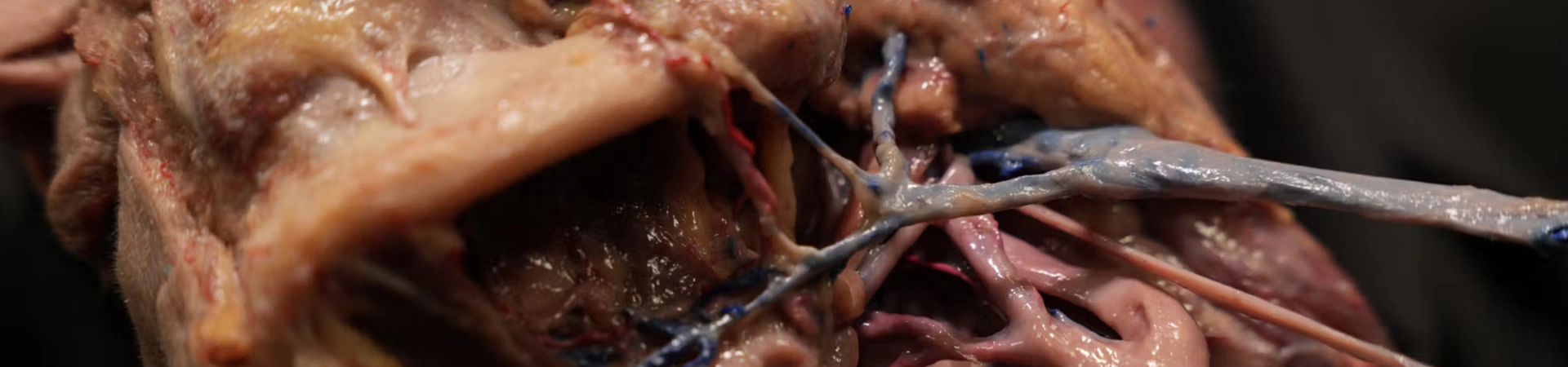 Understanding and Avoiding Toxin-related Adverse Events: Platysma Muscle