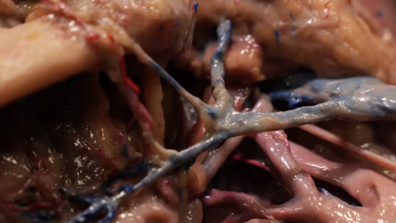 Understanding and Avoiding Toxin-related Adverse Events: Platysma Muscle