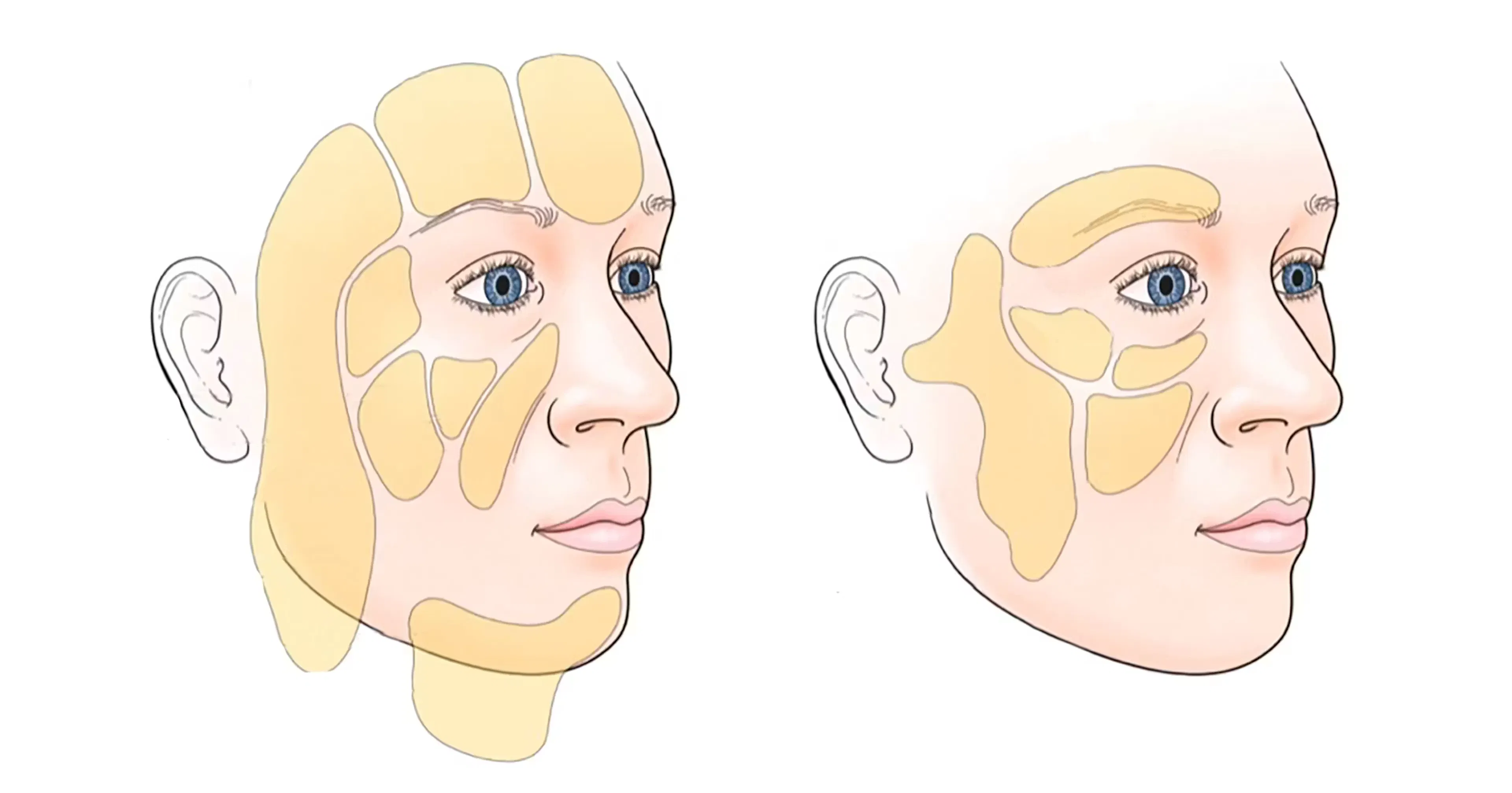 Anatomy of the Facial Fat Compartments diagram