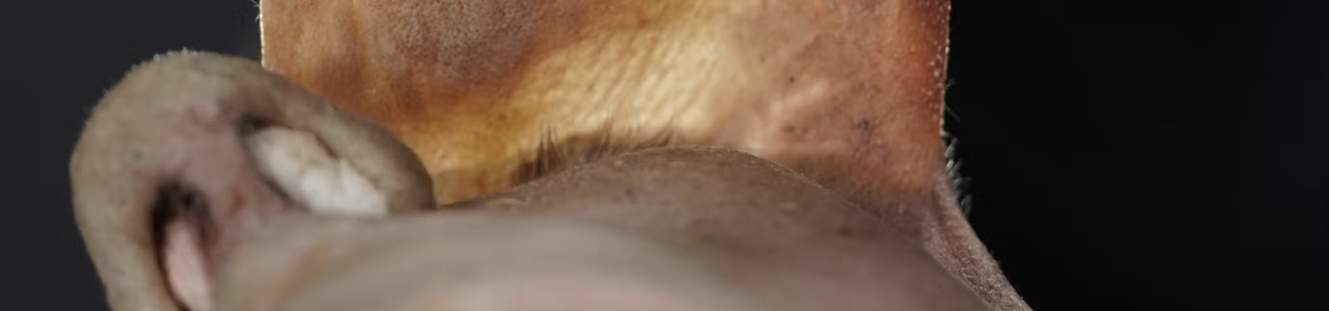Treating Glabellar Lines with Fillers: Intradermal Needle Technique