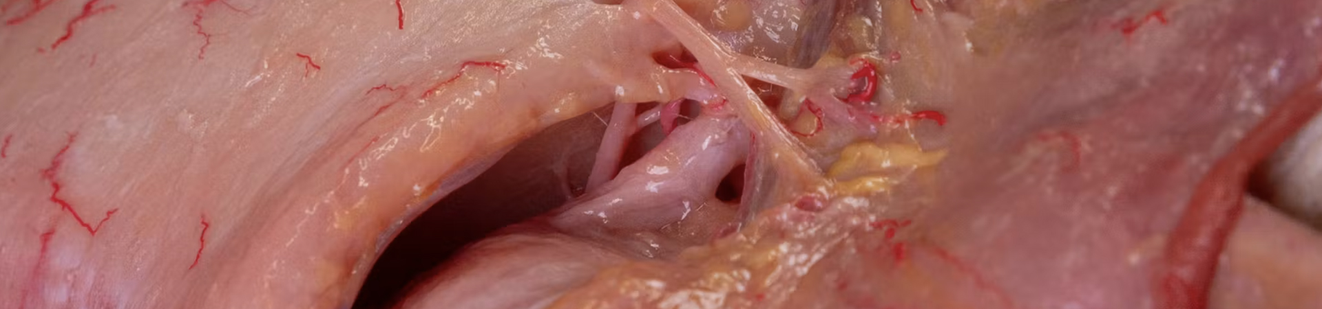 Understanding and Avoiding Toxin-related Adverse Events: Lateral Canthal Lines
