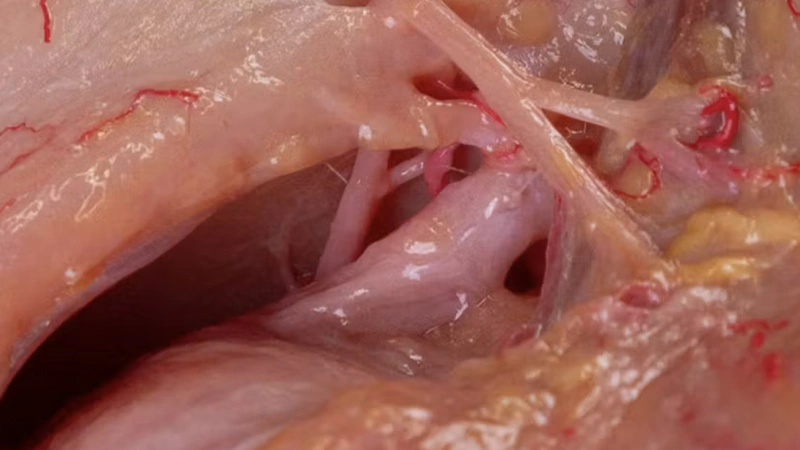 Understanding and Avoiding Toxin-related Adverse Events: Lateral Canthal Lines