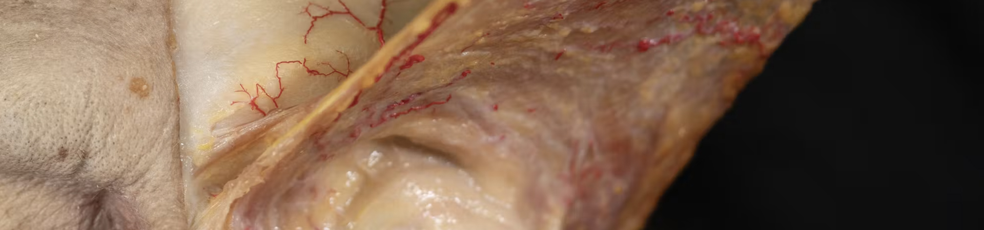 Basic Anatomy for Neuromodulator Treatments: Glabella