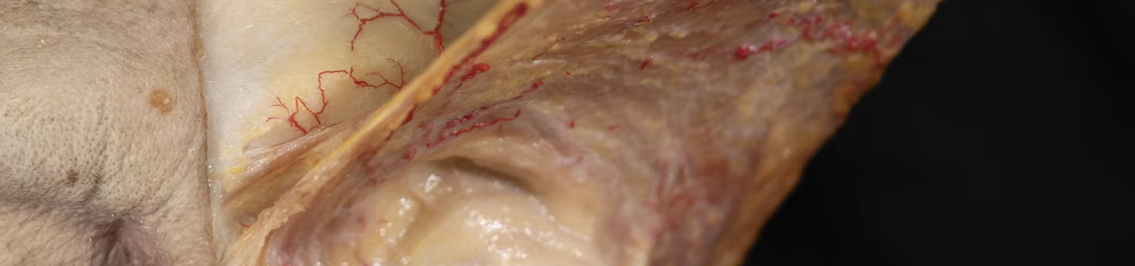 Basic Anatomy for Neuromodulator Treatments: Glabella