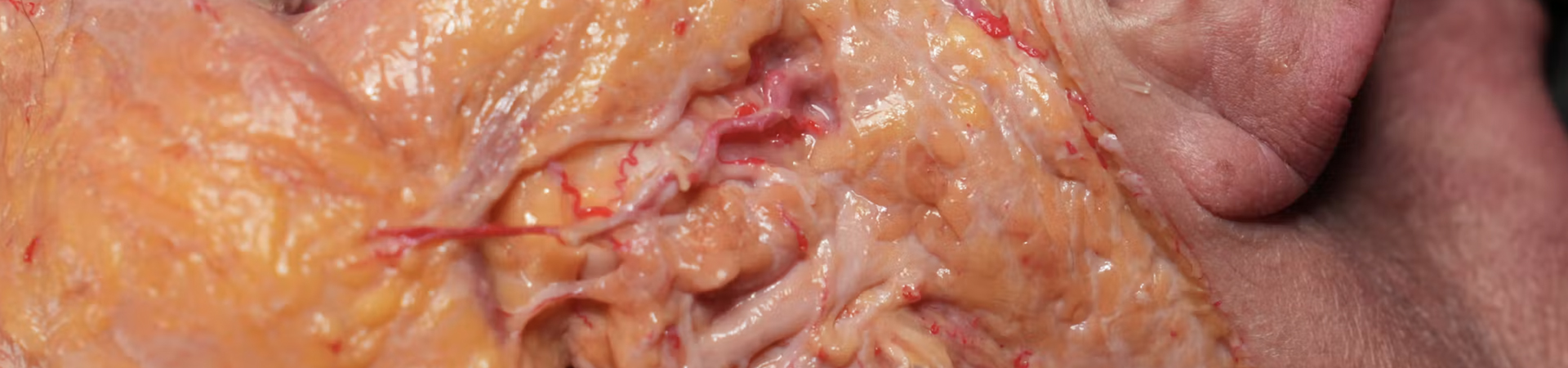 Superficial Zygomatic Arch Enhancement with Cannula