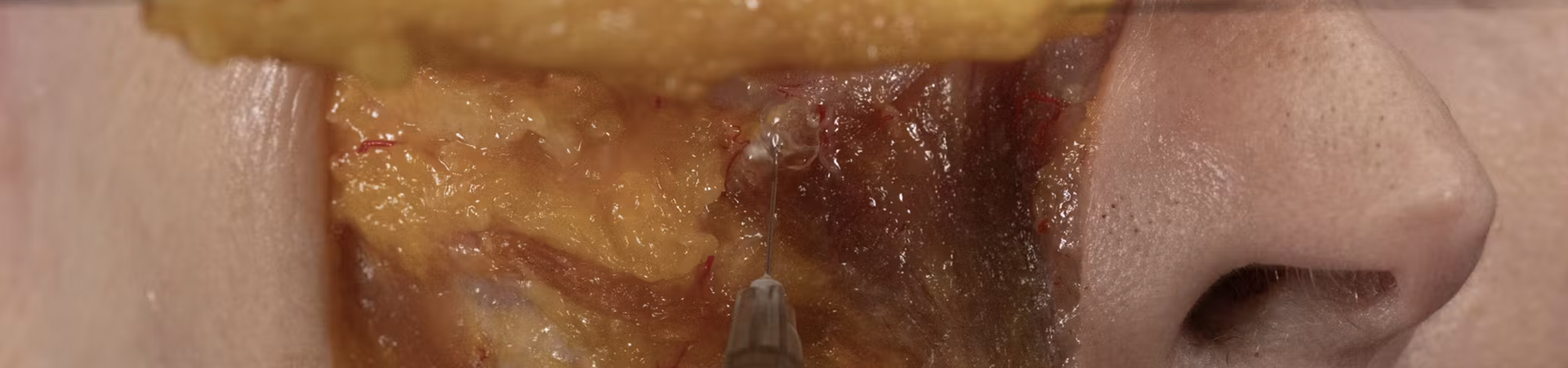 Anterior Midface Volumization: Deep Needle Technique