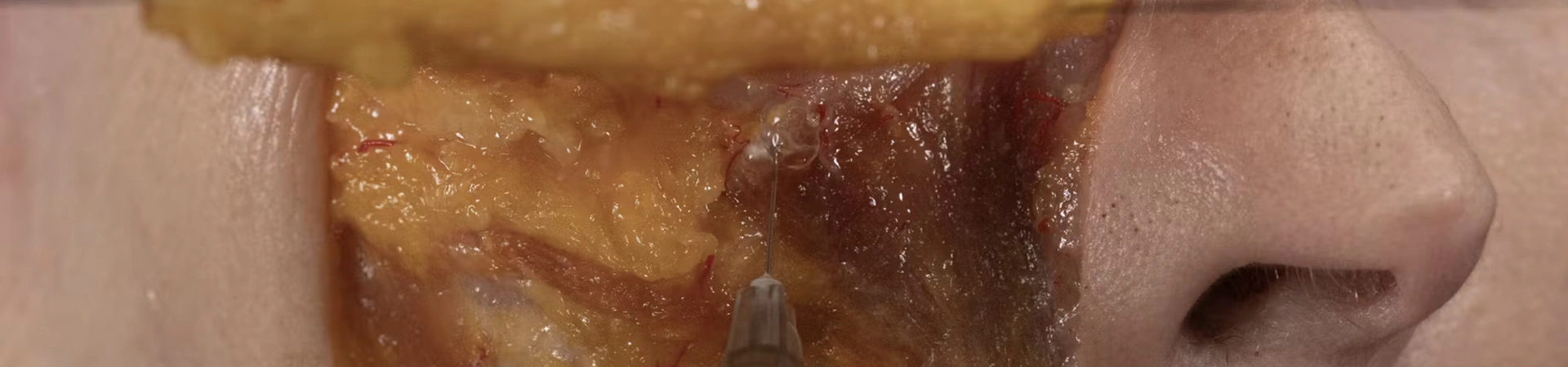 Anterior Midface Volumization: Deep Needle Technique