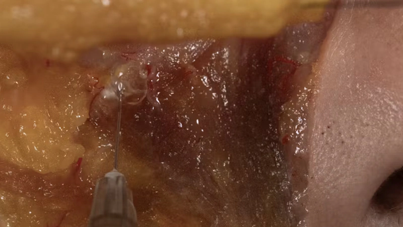 Anterior Midface Volumization: Deep Needle Technique