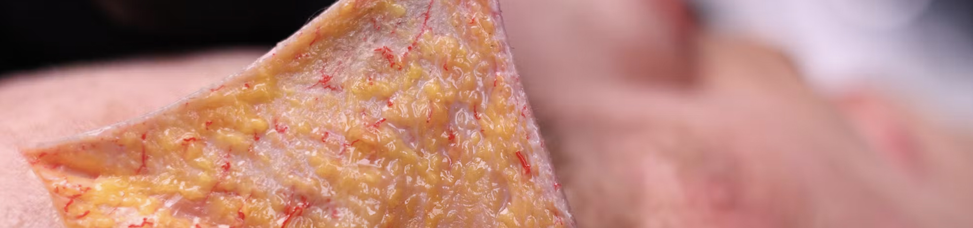 Understanding and Avoiding Toxin-related Adverse Events: Frontalis Muscle