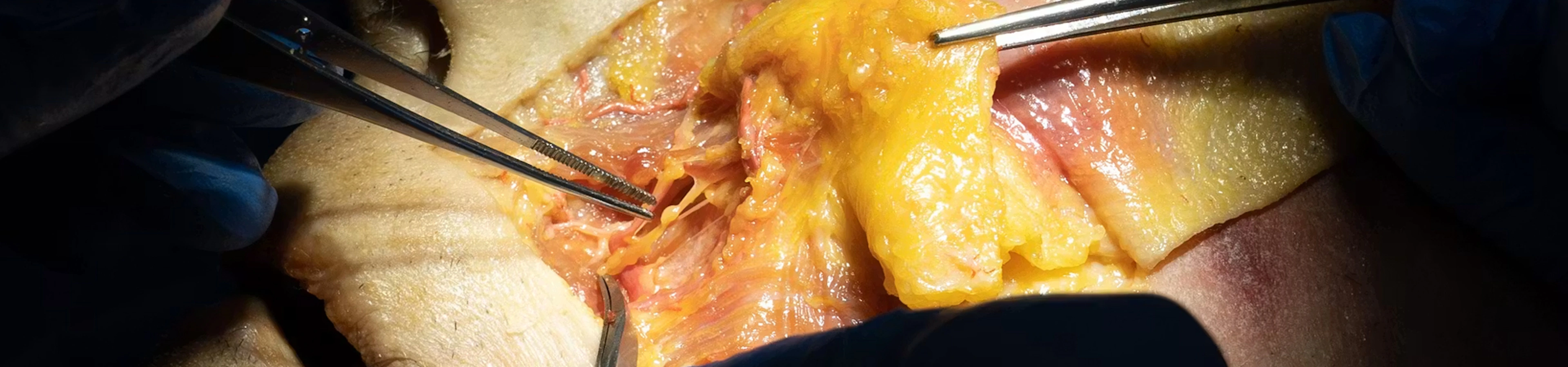 Nasolabial fold Treatments: Combined Treatments with Needle and Cannula