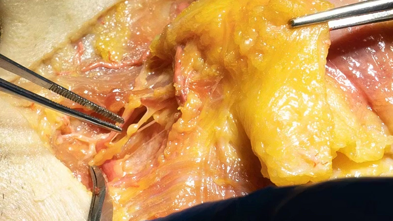 Nasolabial fold Treatments: Combined Treatments with Needle and Cannula