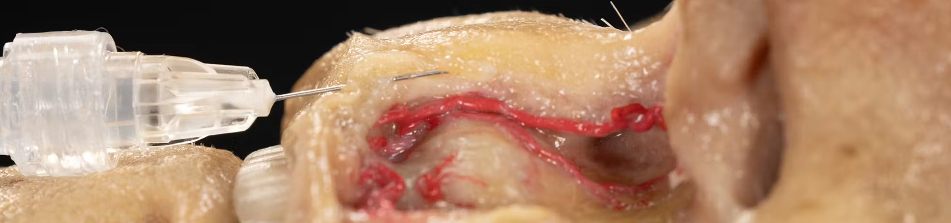 Perioral Treatments: Addressing Barcode Lines with Needle