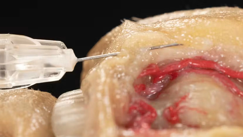 Perioral Treatments: Addressing Barcode Lines with Needle