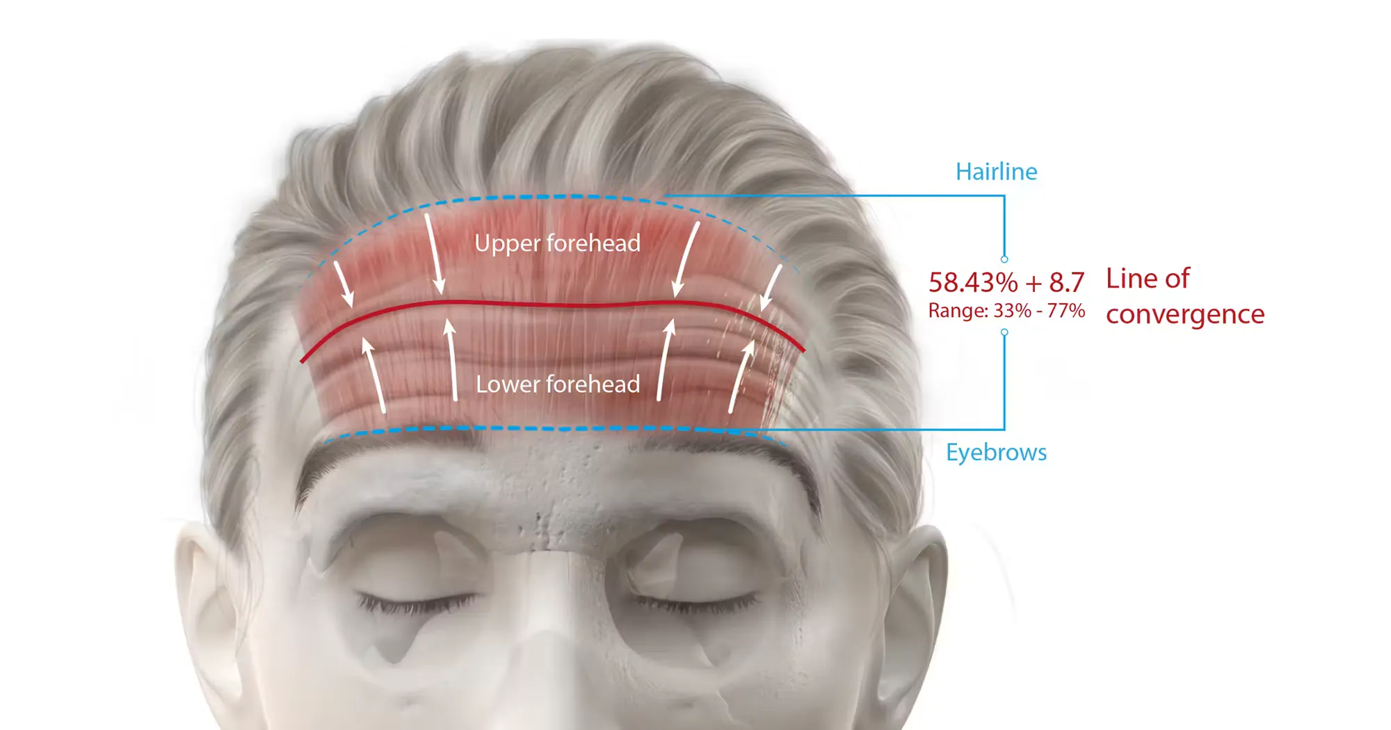 line of convergence - upper head diagram