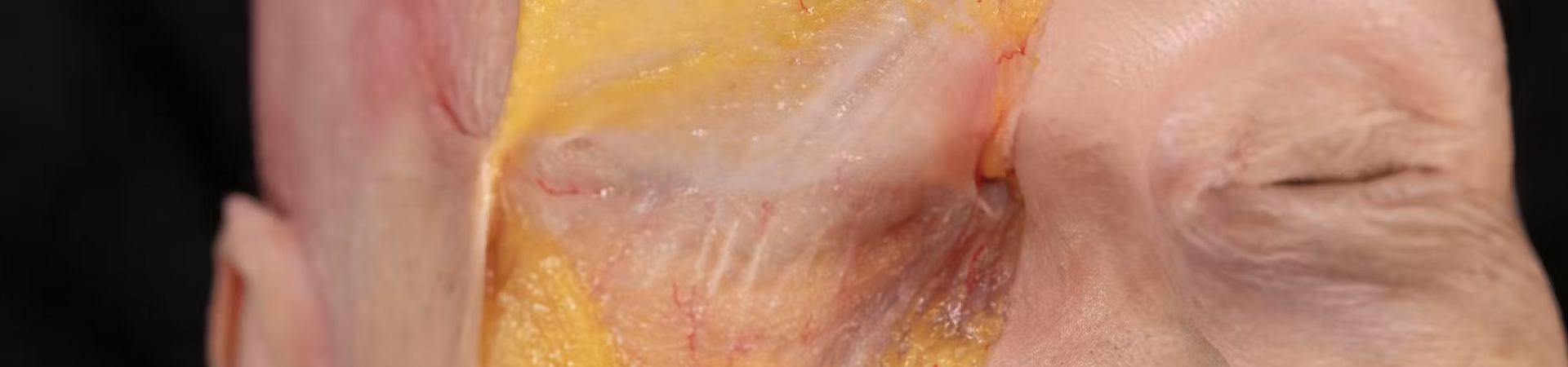 Nasolabial fold Treatments: Superficial Cannula Technique