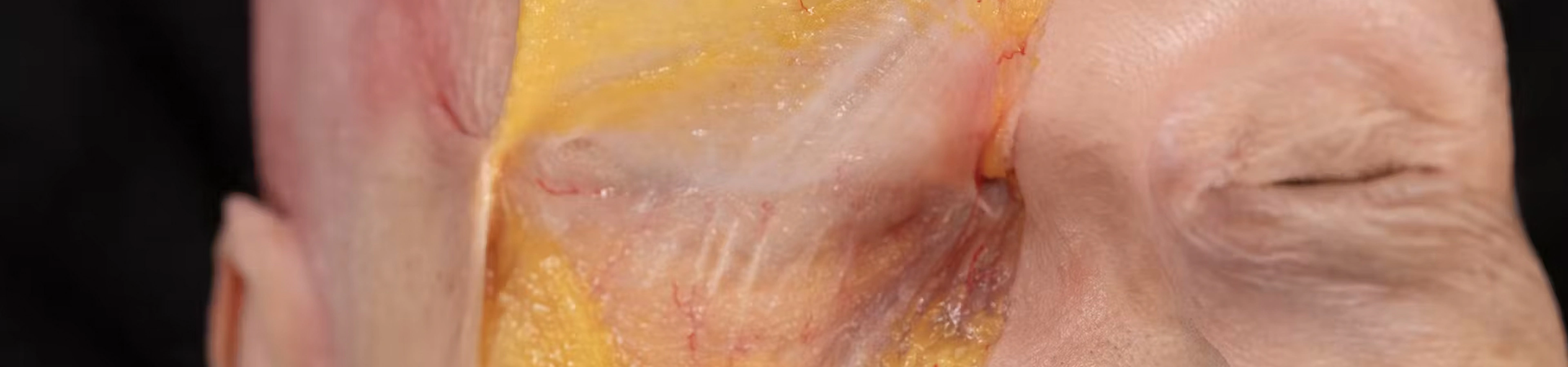 Nasolabial fold Treatments: Superficial Cannula Technique