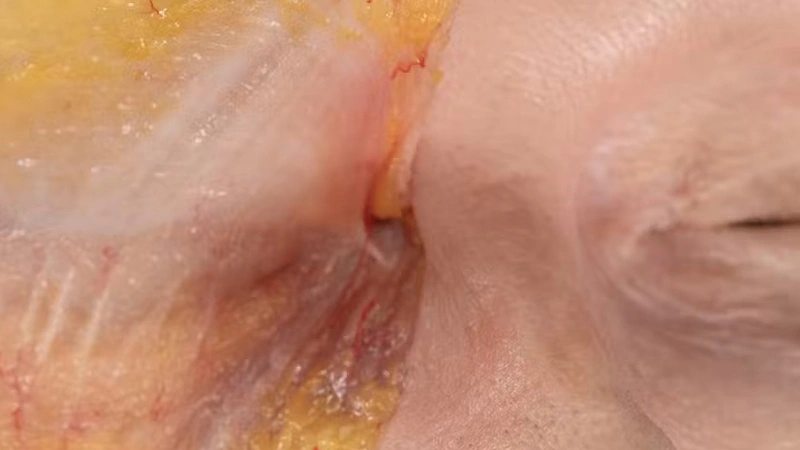 Nasolabial fold Treatments: Superficial Cannula Technique