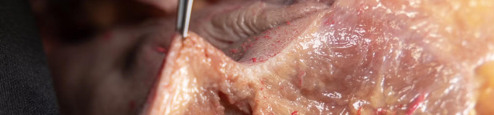 Basic Anatomy for Neuromodulator Treatments: Mentalis Muscle