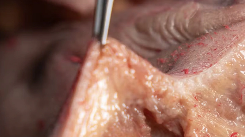 Basic Anatomy for Neuromodulator Treatments: Mentalis Muscle