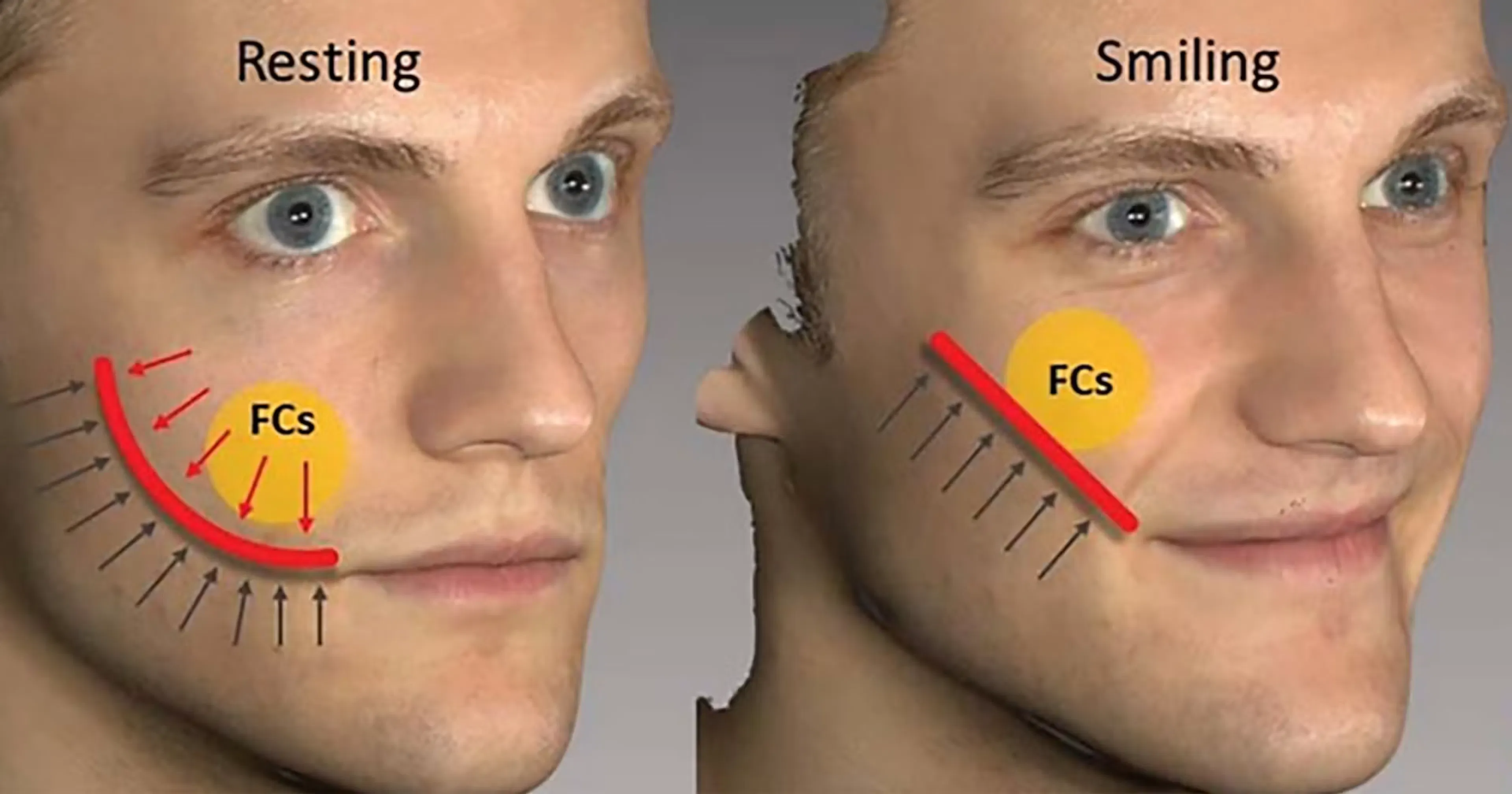 Facial Overfilled Syndrome diagram