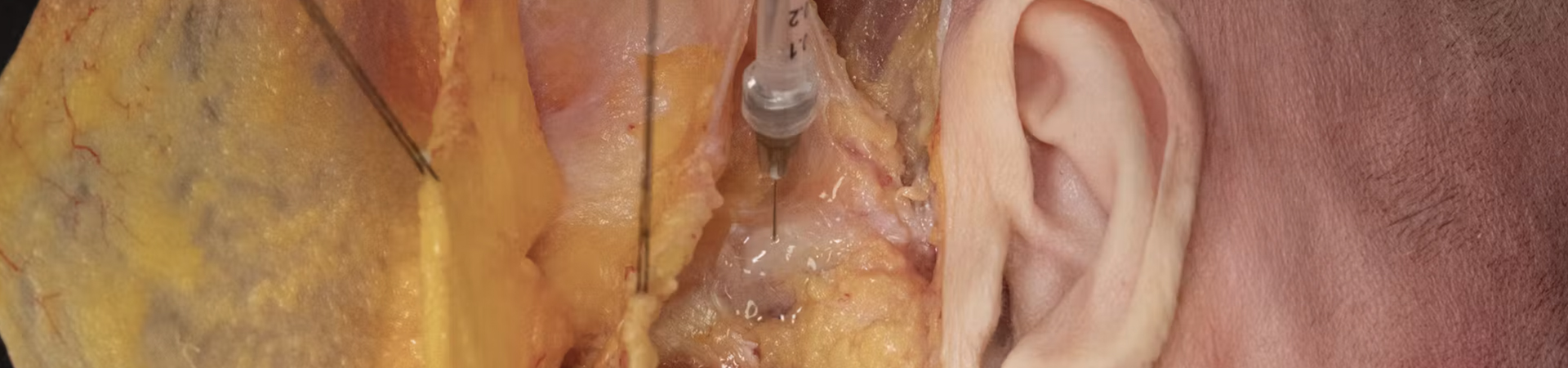 Zygomatic Arch Enhancement with Needle