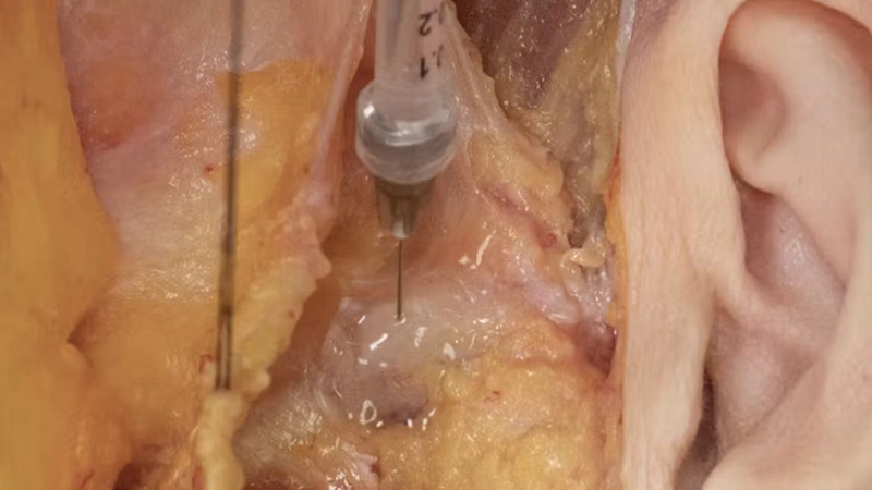 Zygomatic Arch Enhancement with Needle