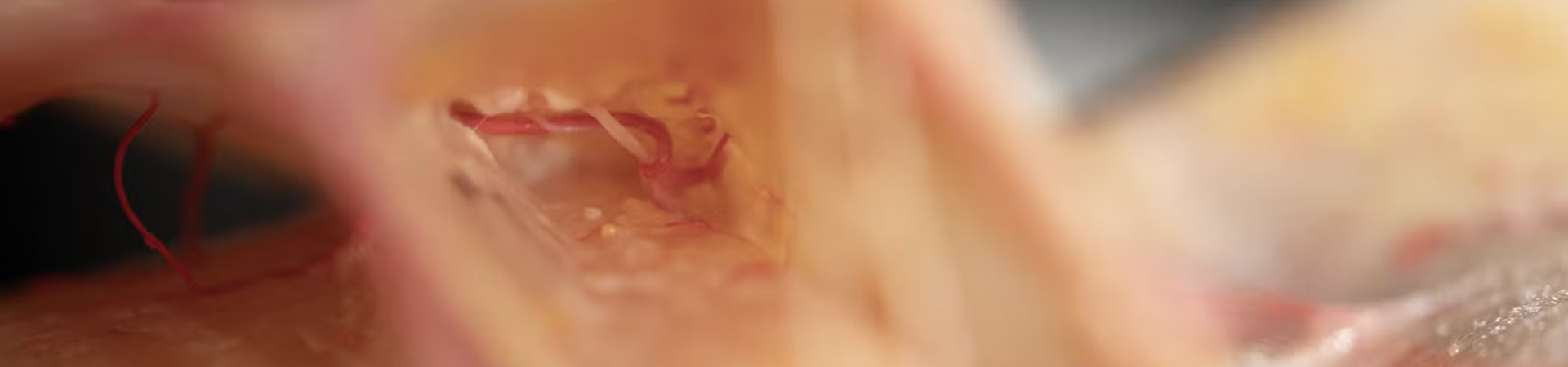 Periorbital Treatments: Palpebromalar grooves with Cannula (Lateral Approach)