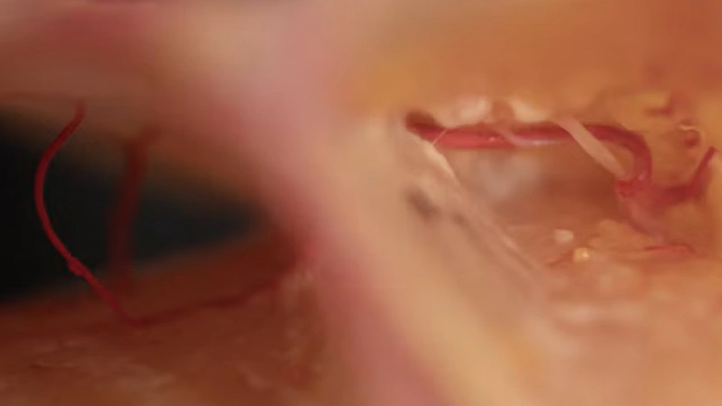 Periorbital Treatments: Palpebromalar grooves with Cannula (Lateral Approach)