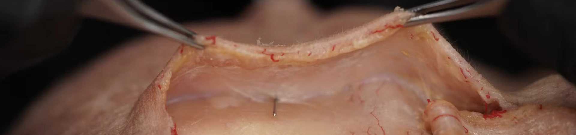 Treating Frontal Hollowing: Deep Cannula Technique