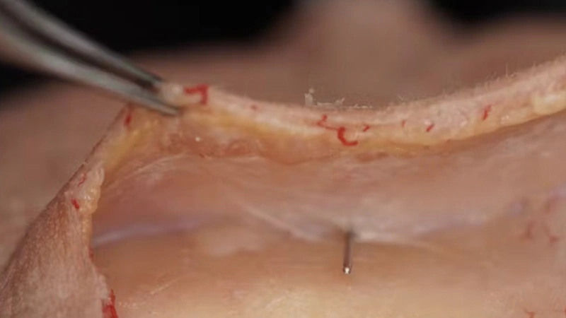 Treating Frontal Hollowing: Deep Cannula Technique