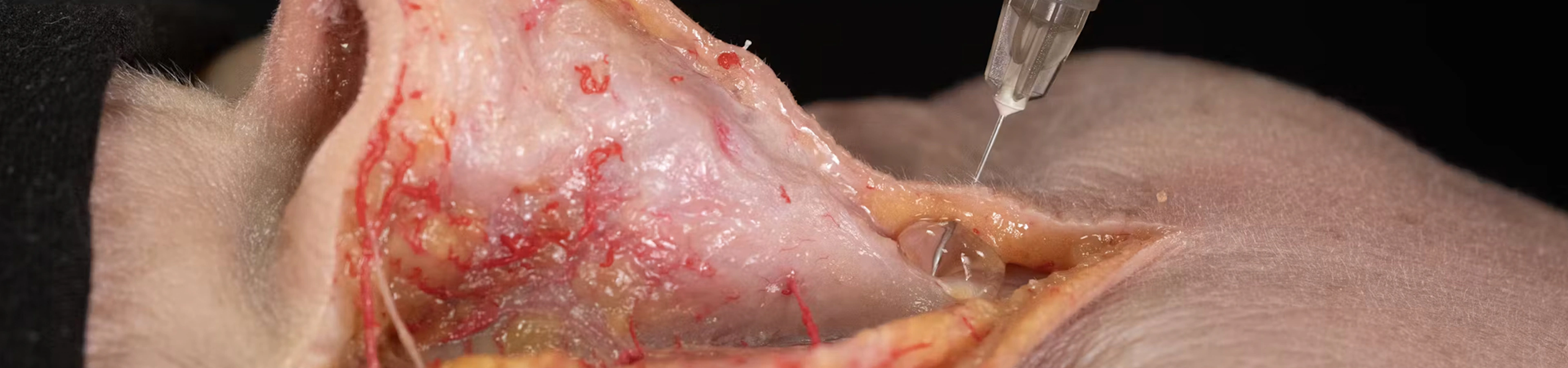 Nose Treatments: Dorsal Enhancement with Needle