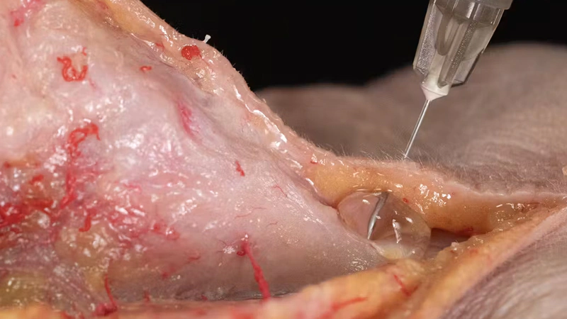 Nose Treatments: Dorsal Enhancement with Needle