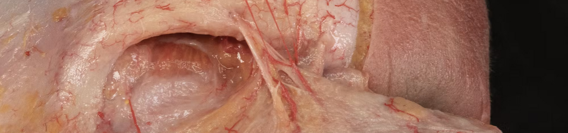 Review: Upper Face - Toxin