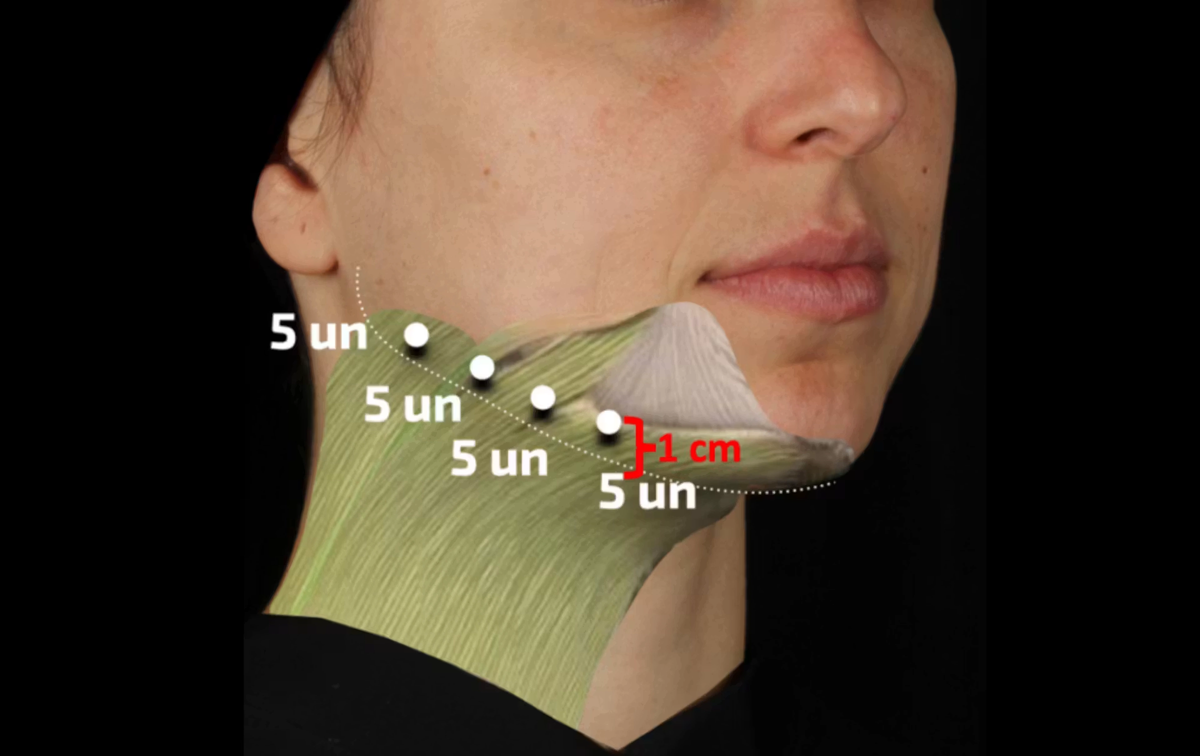 Image highlighting the injection sites along the jawline involved in a toxin lift