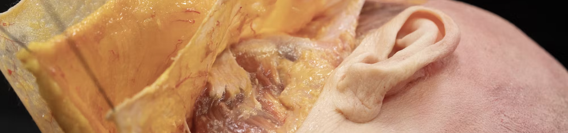 Understanding and Avoiding Toxin-related Adverse Events: Masseter Muscle