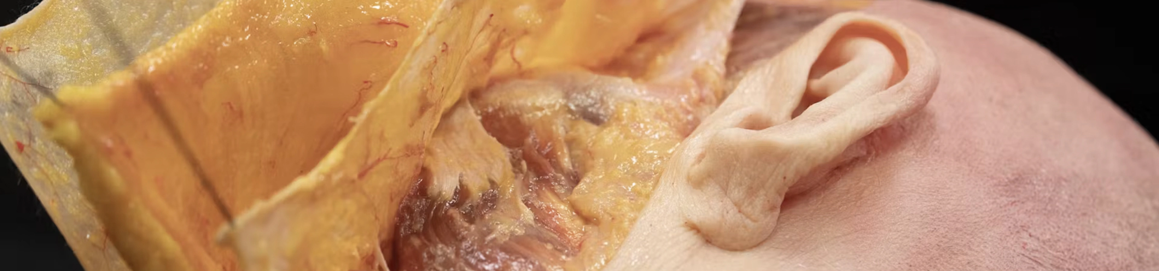 Understanding and Avoiding Toxin-related Adverse Events: Masseter Muscle