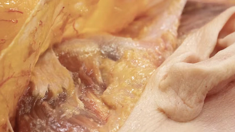 Understanding and Avoiding Toxin-related Adverse Events: Masseter Muscle