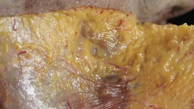 Understanding and Avoiding Toxin-related Adverse Events: Jawline Contouring
