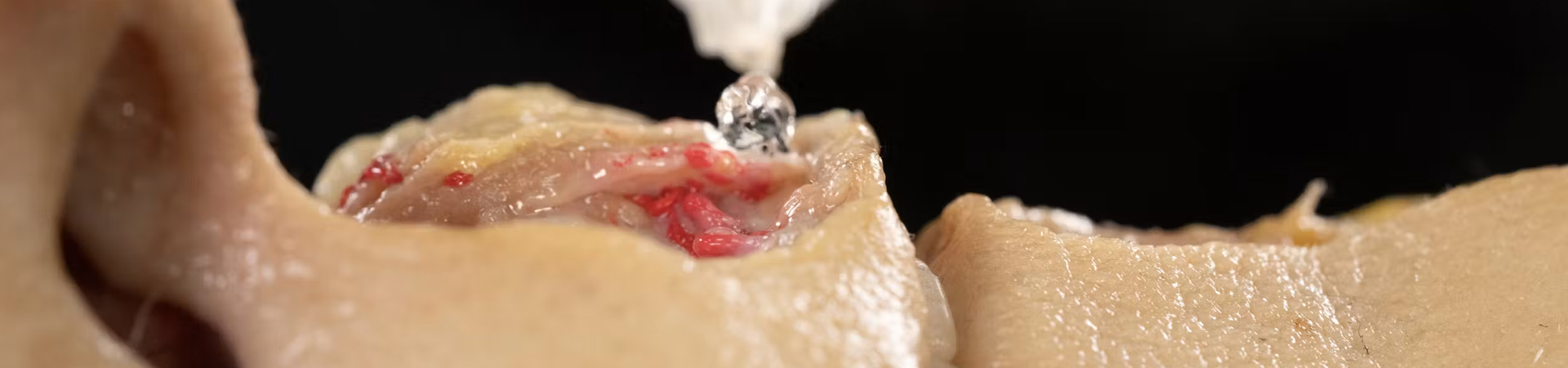 Lip Volumizing with Needle: Horizontal Technique