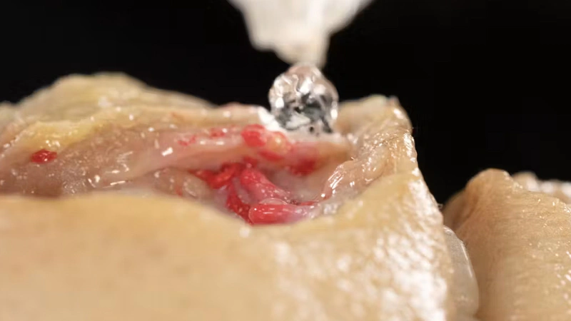 Lip Volumizing with Needle: Horizontal Technique