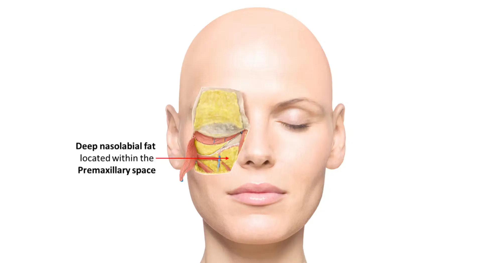 Graphic illustration of the intermediate fat of the medial midface