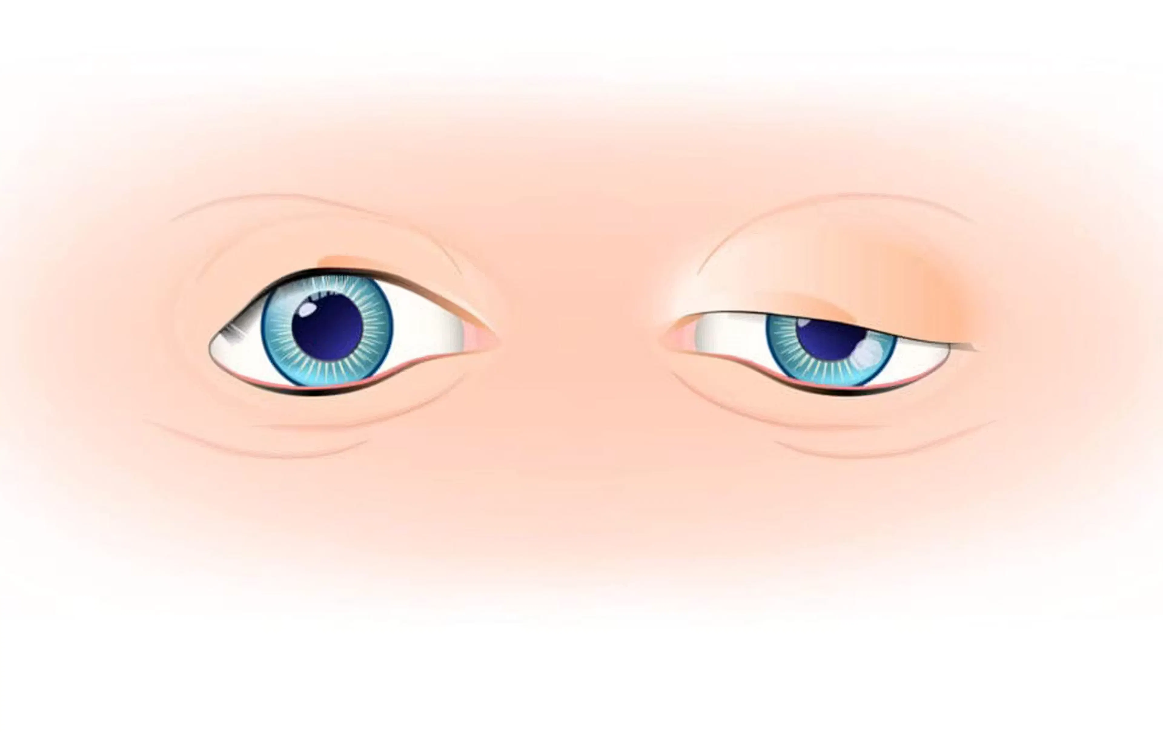 Simulating Upper Eyelid Ptosis illustration