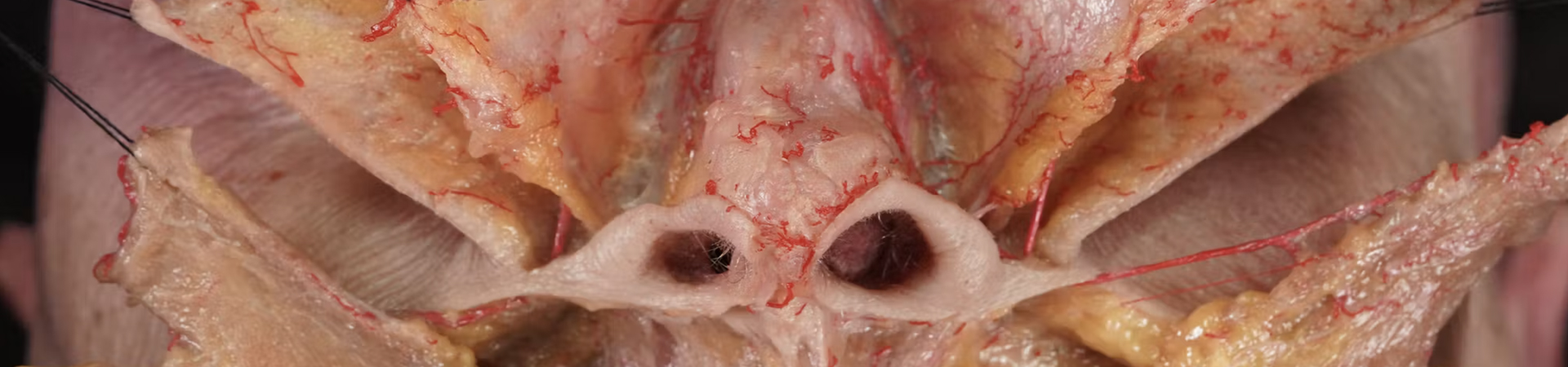 Understanding and Avoiding Toxin-related Adverse Events: Nasalis Muscle