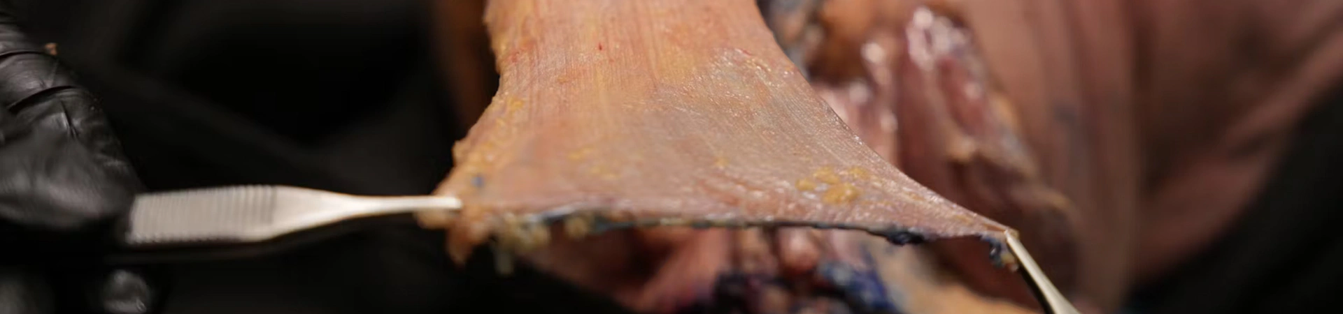 Basic Anatomy for Neuromodulator Treatments: Platysma Muscle