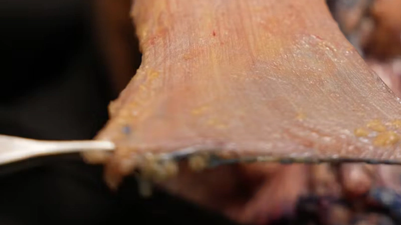 Basic Anatomy for Neuromodulator Treatments: Platysma Muscle