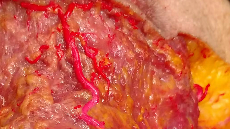 Horizontal Neck Lines Subdermal Cannula Technique